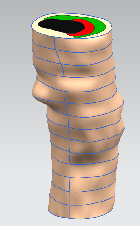 Coronary Artery