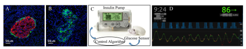 artificial pancreas